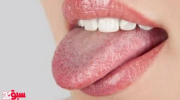 علاج فطريات الفم طبيعياً.. اكتشف أقوى الحلول المنزلية الآمنة والفعالة للقضاء عليها